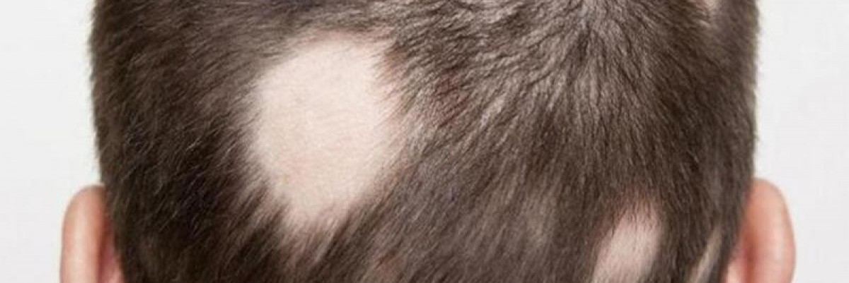 Alopesi Areata: Saçkıran