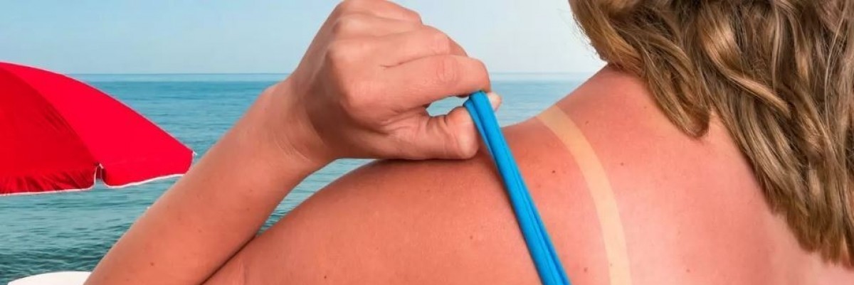 Güneş Yanığına Dikkat