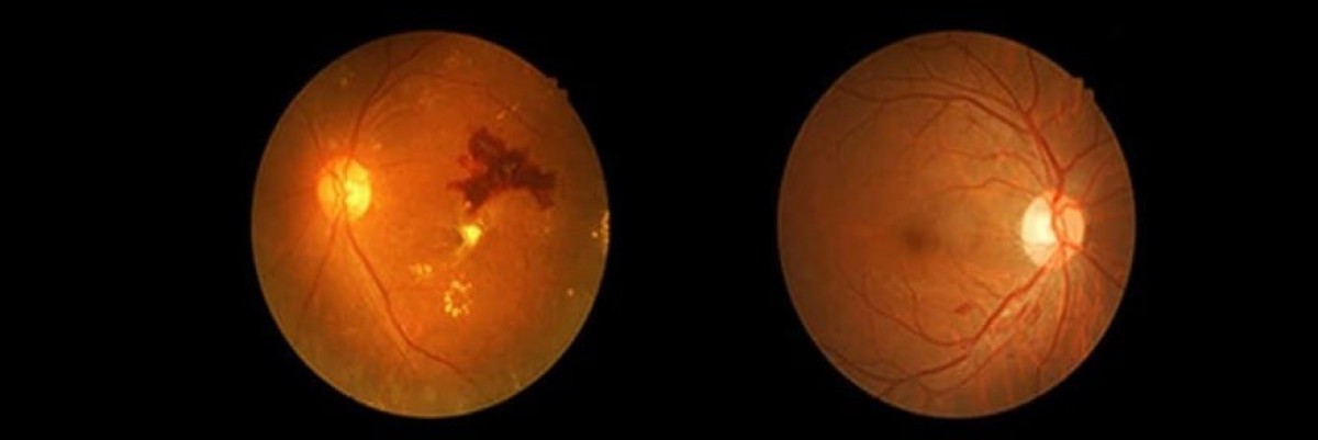 Diyabetik Retinopati