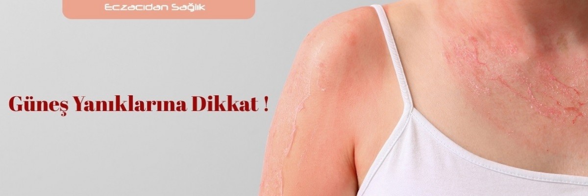 Güneş Yanıklarına Dikkat !